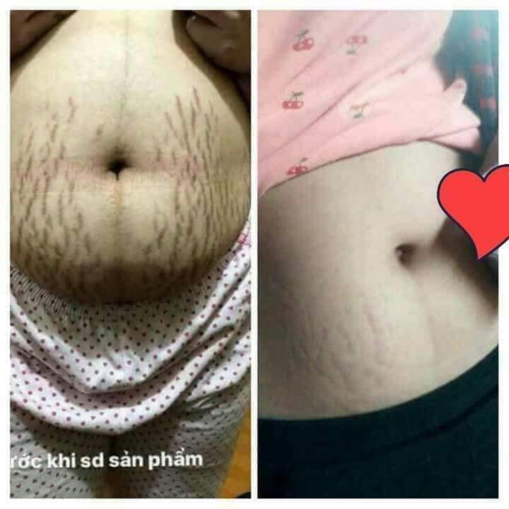 Stretch Mark - Dark Spot - Scars removed